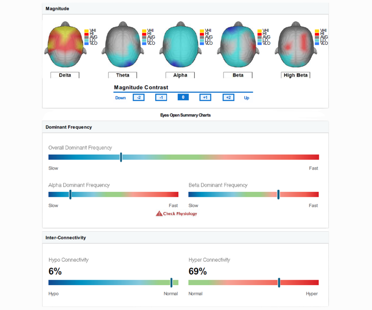 Que es neurofeedback